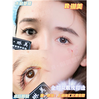琳美整形眼综合整形 