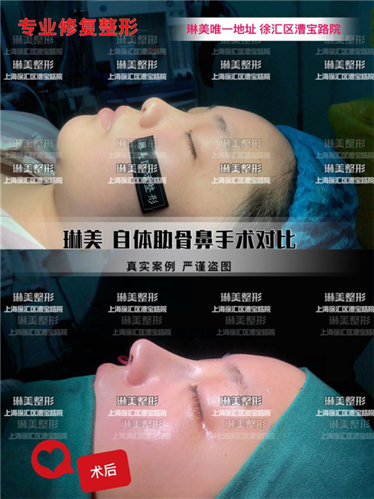上海琳美鼻整形