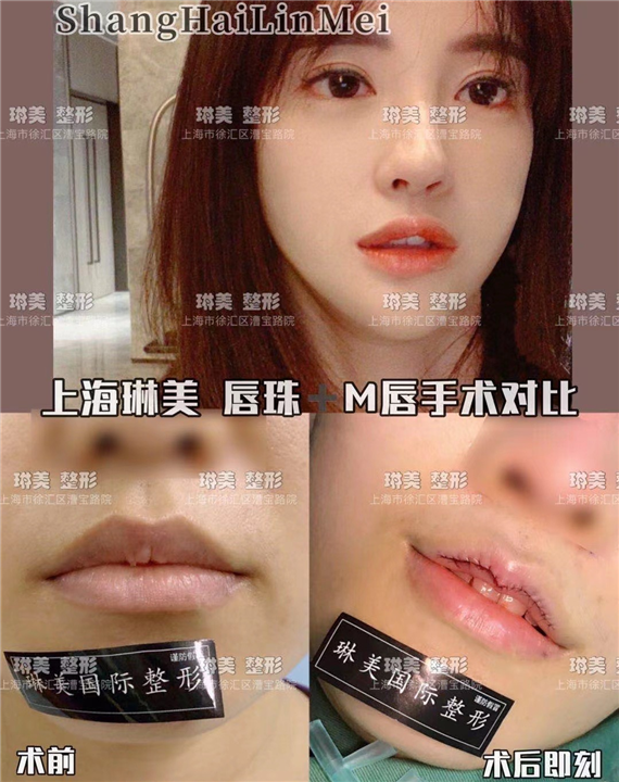 上海琳美M唇整形
