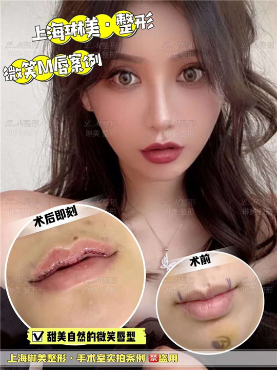 上海琳美M唇整形