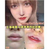 上海琳美M唇整形