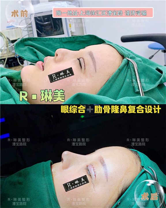 上海琳美鼻整形