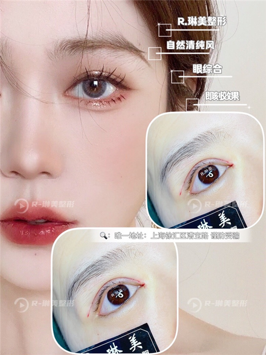 琳美整形眼综合整形 
