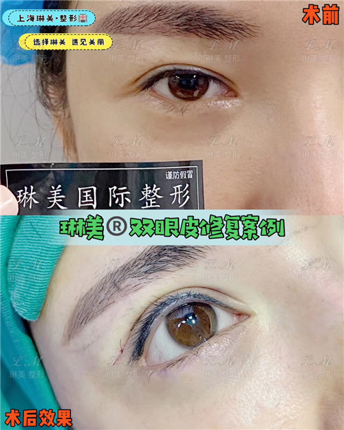 上海琳美眼综合整形