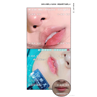 琳美唇部整形