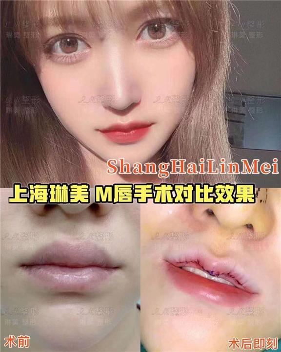 上海琳美M唇整形