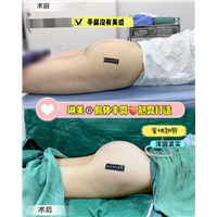 上海琳美丰臀整形