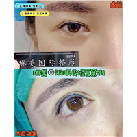 上海琳美眼综合整形
