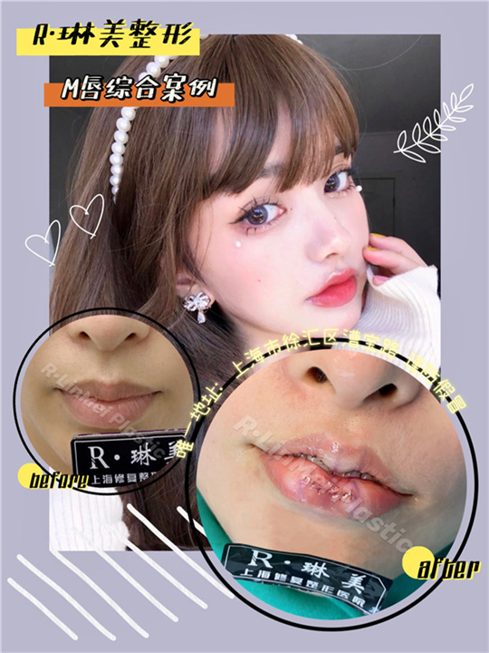 上海琳美M唇整形