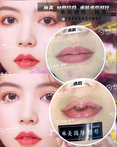 琳美M唇整形 
