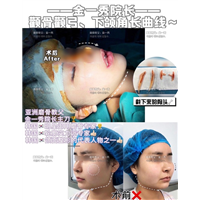 上海专业磨骨专家 