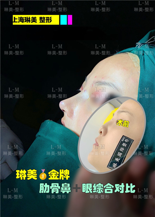 上海琳美鼻整形
