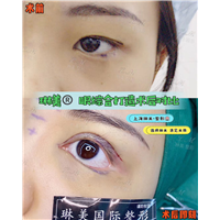 上海琳美眼综合整形