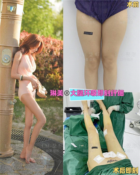 上海琳美吸脂整形