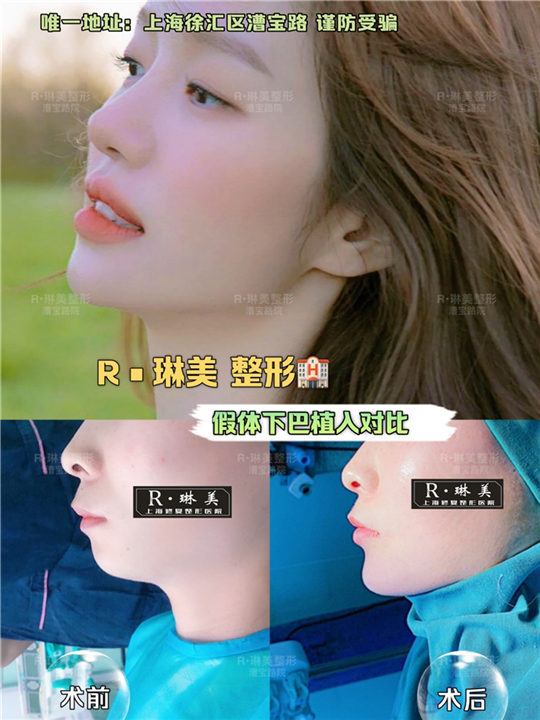 上海琳美下巴整形