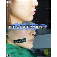 上海琳美下巴整形