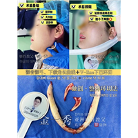 上海磨骨整形专家 