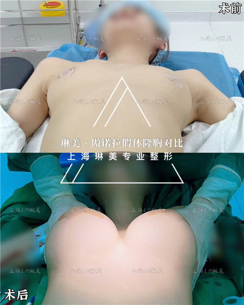 上海琳美隆胸整形