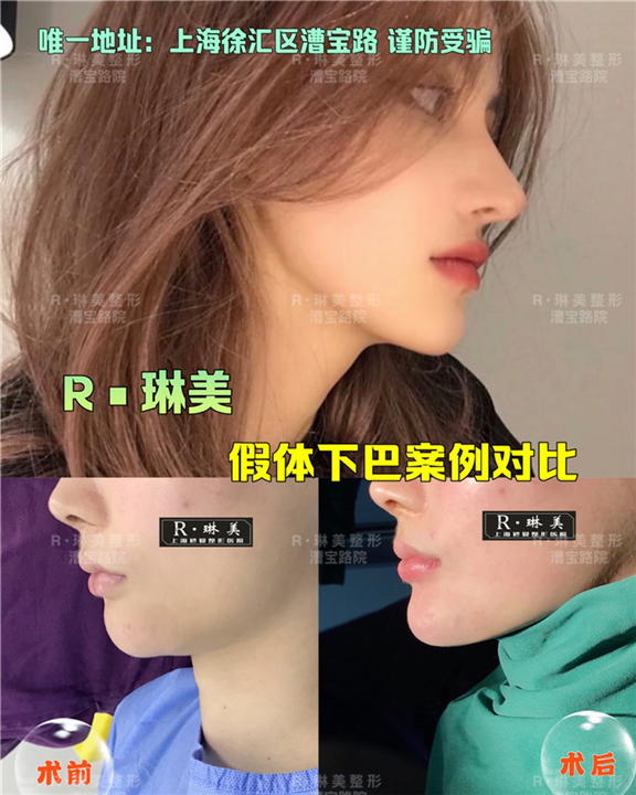 上海琳美下巴整形