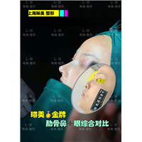 上海琳美鼻整形