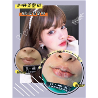 上海琳美M唇整形