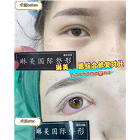 上海琳美眼综合整形