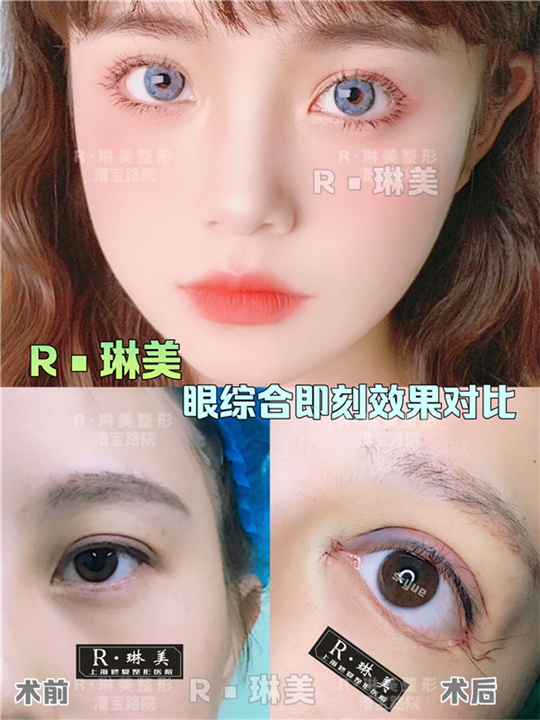 上海琳美眼综合整形