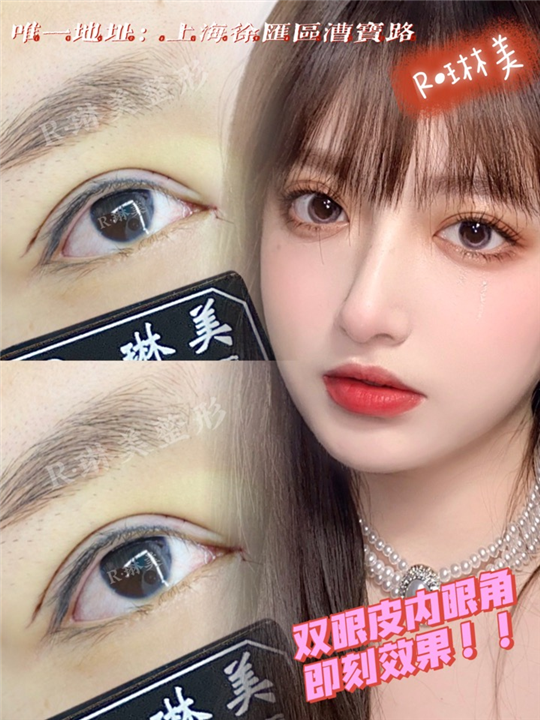 琳美整形眼综合整形 