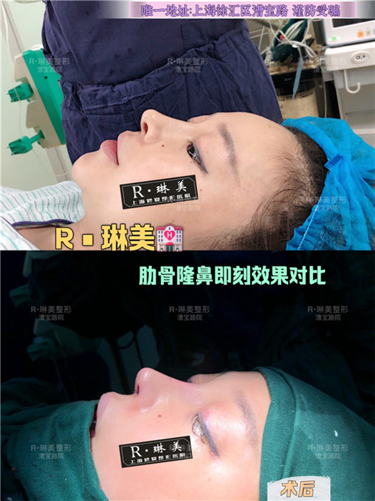 上海琳美鼻整形