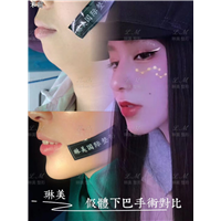 上海琳美下巴整形