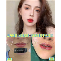 上海琳美M唇整形