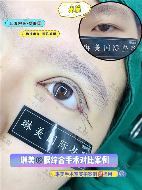 上海琳美眼综合整形