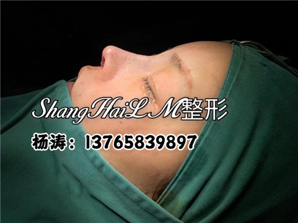 上海琳美鼻整形