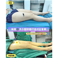 上海琳美吸脂瘦身
