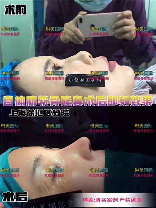琳美整形鼻综合整形 