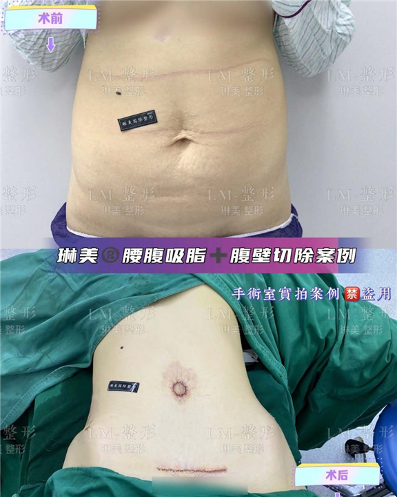 上海琳美吸脂整形