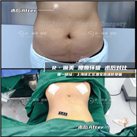 琳美整形腰腹吸脂 