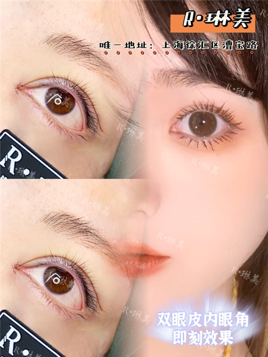 琳美整形眼综合整形 