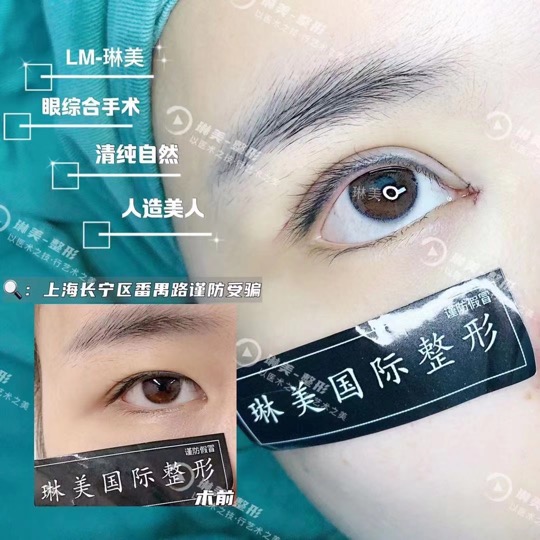 琳美整形眼综合整形 