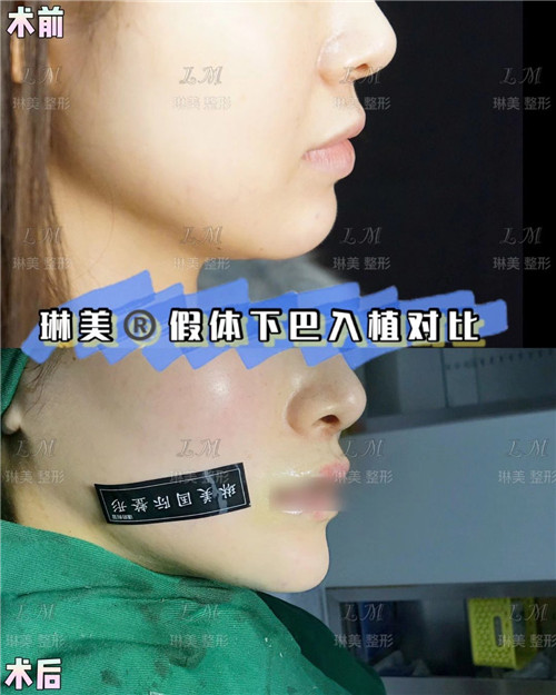 上海琳美下巴整形