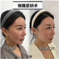 微雕紧妍术