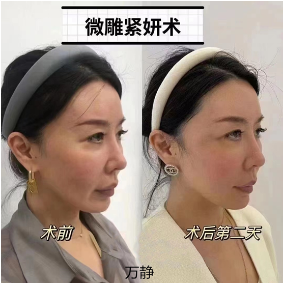 微雕紧妍术