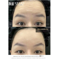 任丘友谊整形抬头纹效果对比