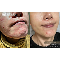 任丘友谊整形祛痘案例对比