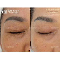 任丘友谊整形眼周抗衰老对比