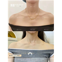 任丘友谊整形瘦肩针术后效果