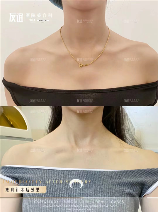 任丘友谊整形瘦肩针术后效果