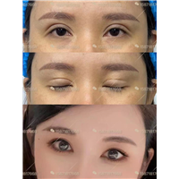 张鹤亭双眼皮案例