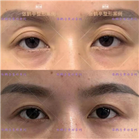 张鹤亭双眼皮案例