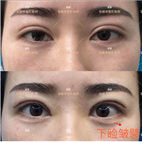 张鹤亭眼睛做的怎么样